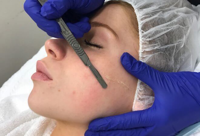 Dermaplaning treatment, med spa service