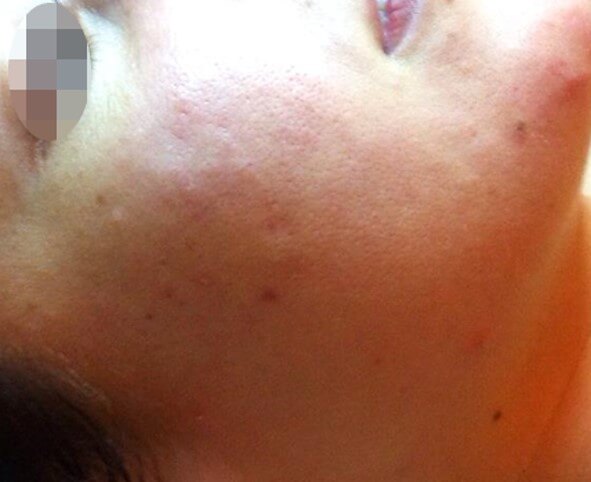 acne after treatment