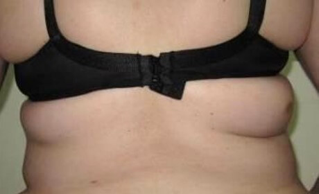 body contouring med spa service before