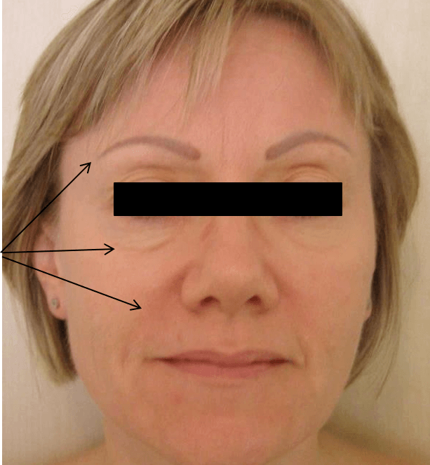 skin rejuvenation, wrinkle reduction med spa service before 2