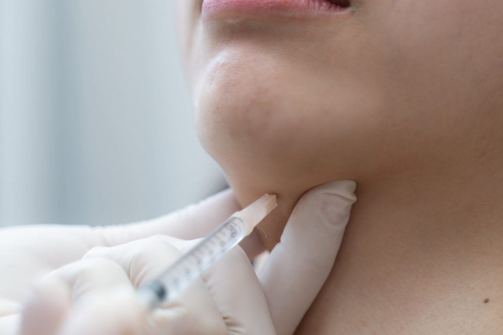 woman receiving kybella treatment, injection in her chin